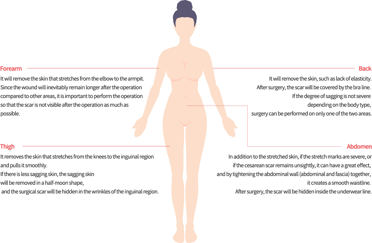 body_lift model img
