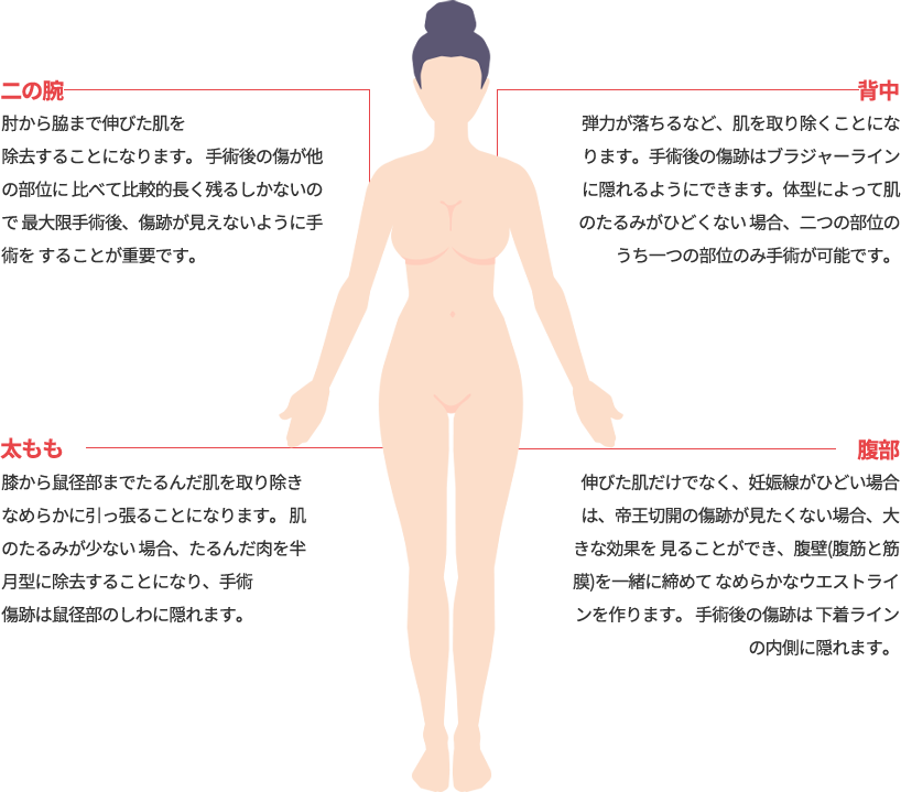 body_lift model img