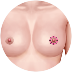 nipple_img12