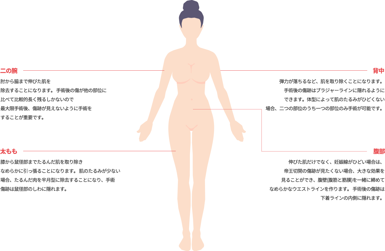 body_lift model img