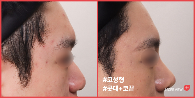 엣지 성형외과&피부과 코 성형 BEFORE / AFTER