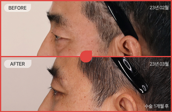 ด้านข้างของใบหน้า