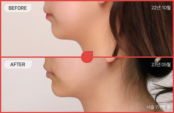 ด้านข้างของใบหน้า