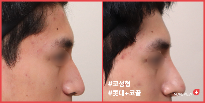 엣지 성형외과&피부과 코 성형 BEFORE / AFTER