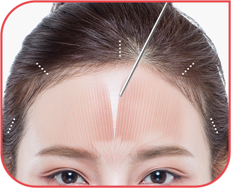forehead_lift img
