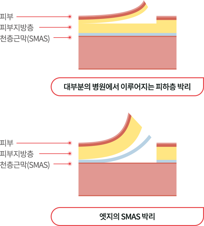 mini_incisio_img04_m