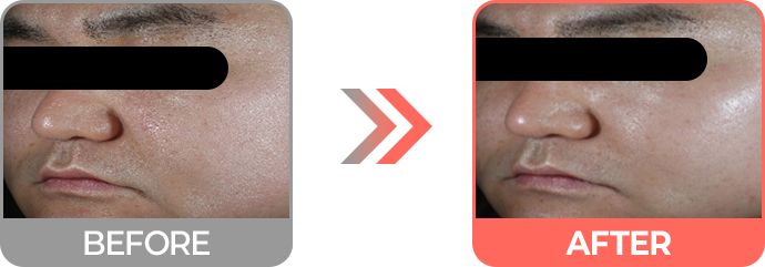 리투오 효과 기미/잡티/광채 개선