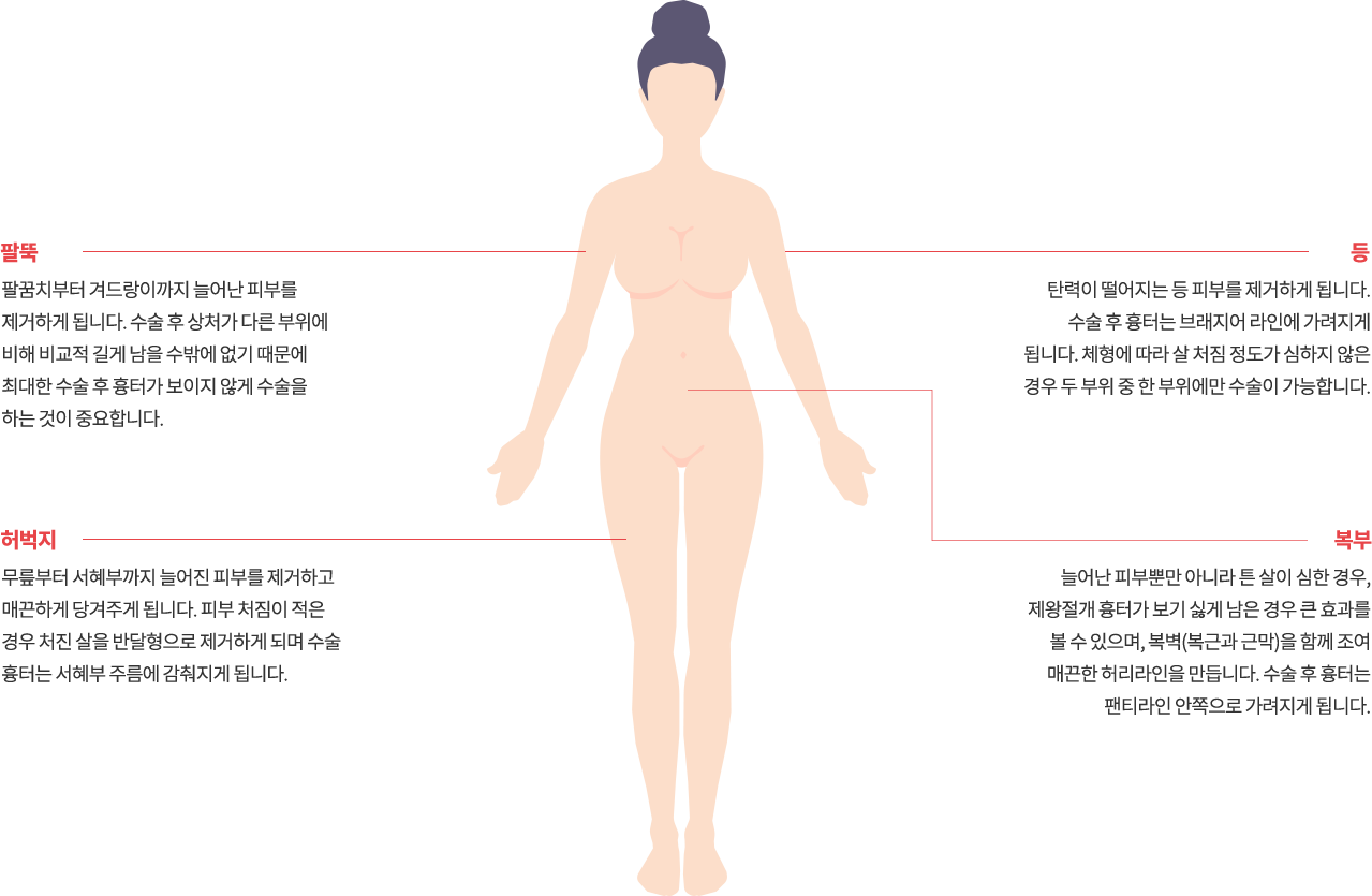 body_lift model img